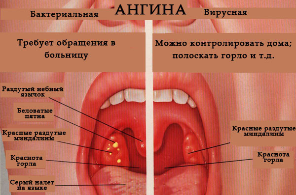 Первые признаки ангины и ее формы