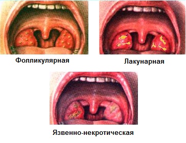 Классификация заболевания в зависимости от симптомов