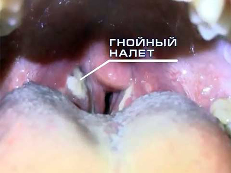 Гнойный налет на миндалинах при ангине