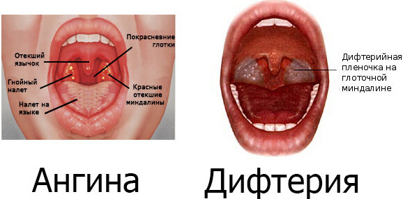 Как отличить ангину от дифтерии и как они выглядят