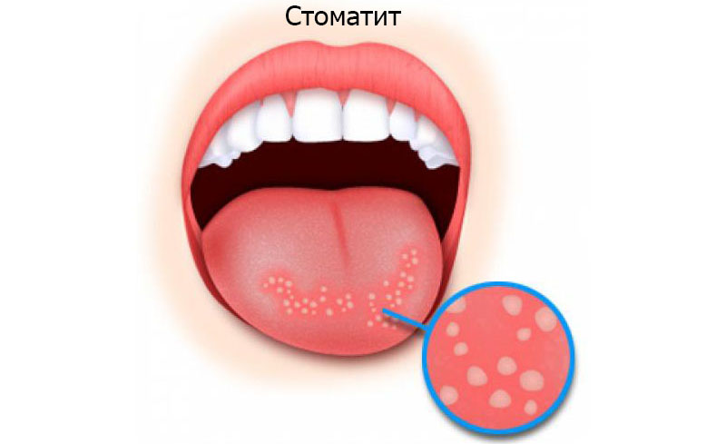 Как отличить ангину от стоматита и как выглядит стоматит