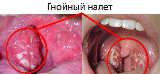 Гнойная ангина у детей