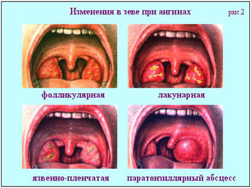 Лечение ангины мороженым после удаления миндалин