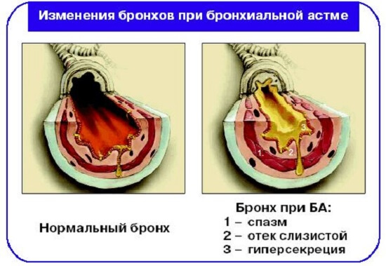 Изменения бронхов при астме