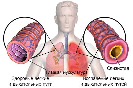 Как выглядят легкие при астме