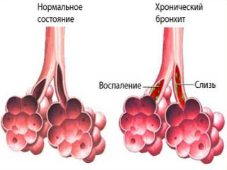 Хронический бронхит