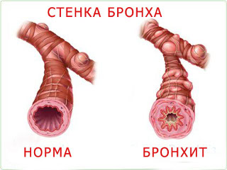 Бронхит