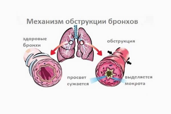 Механизм обструкции легких