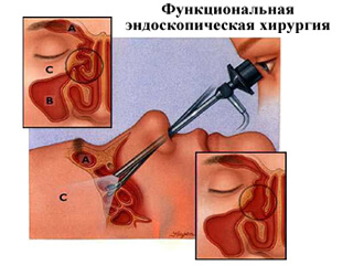 Хирургическое лечение фронтита
