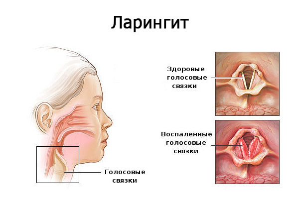 Ларингит