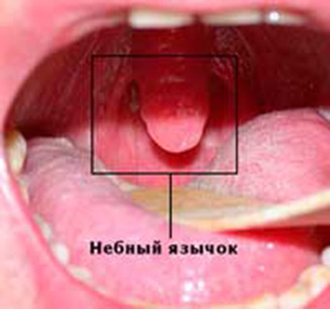 Опух небный язычок