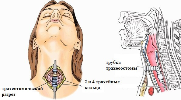 Отек горла