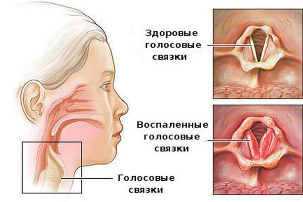 Как выглядит ларингит