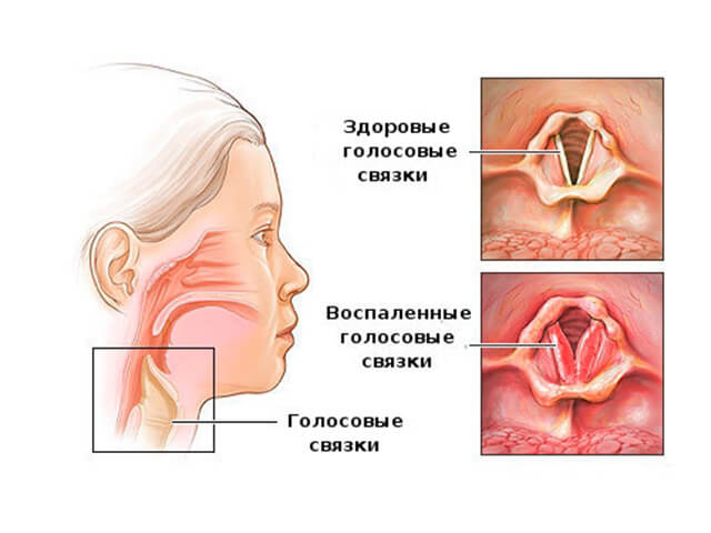 Ларингит