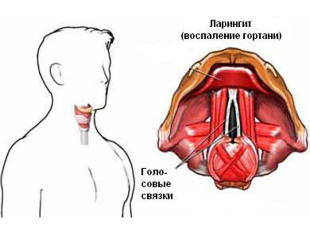 Как лечить больные связки горла