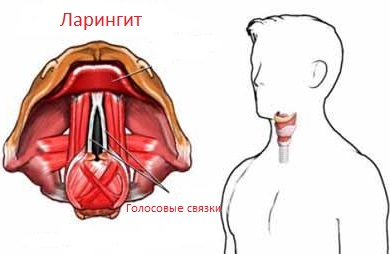 Ларингит