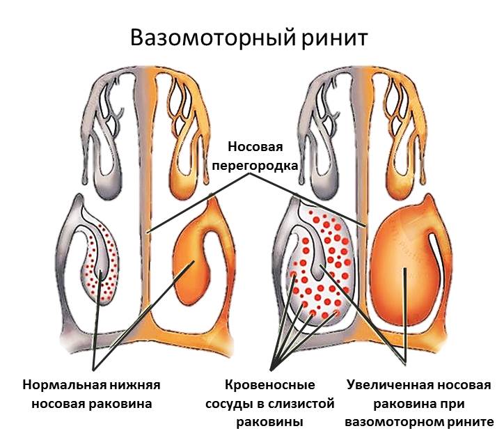 Вазомоторный аллергический ринит