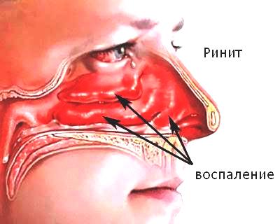 Как вылечить вазомоторный ринит