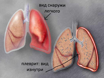 Плеврит легких: что это такое