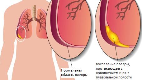 Осложнения от плеврита