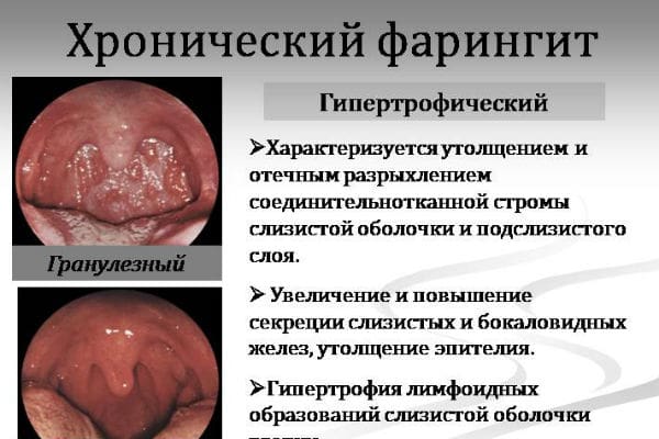 Хронический фарингит, симптомы и лечение у взрослых