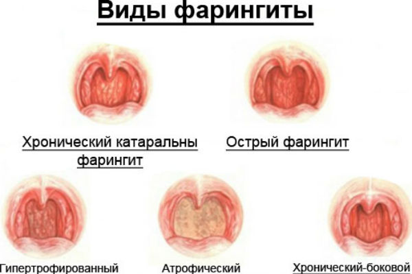 Виды фарингита