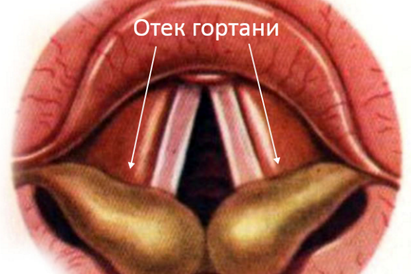 Отек гортани