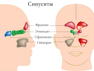 Сфеноидит