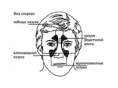 Синусит: воспаление пазух черепа