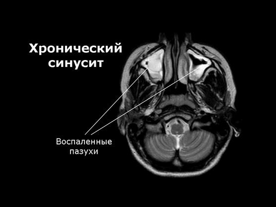 Признаки синусита хронического