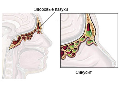 Здоровые пазухи и пазухи при синусите