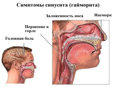Симптомы синуситов