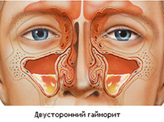 Двухсторонний верхнечелюстной синусит
