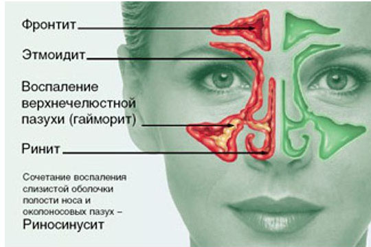 Риносинусит что это. Виды риносинусита