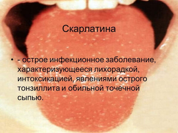 Определение скарлатины