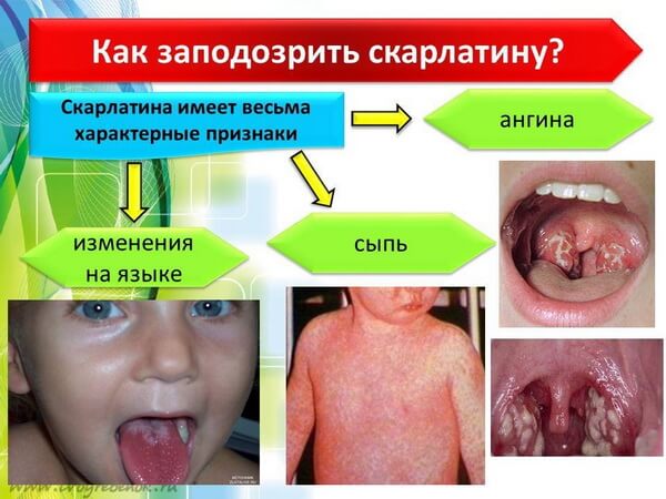 Как заподозрить скарлатину