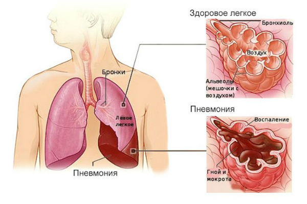 Температура и кашель - симптомы воспаления легких у детей