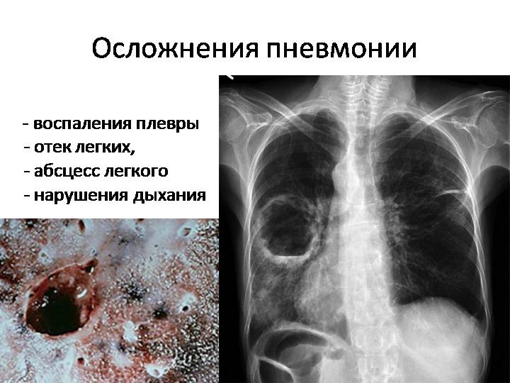 Пневмония: симптомы, признаки воспаления легких