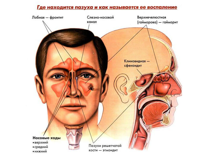 Чем отличается синусит от гайморита. Локализацией заболевания в пазухах
